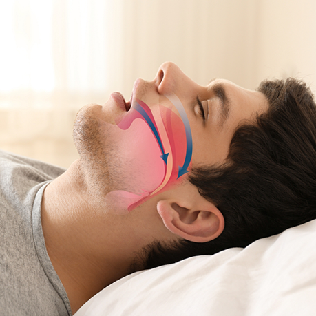 Man sleeping on his back with his mouth open with illustration showing his blocked airway